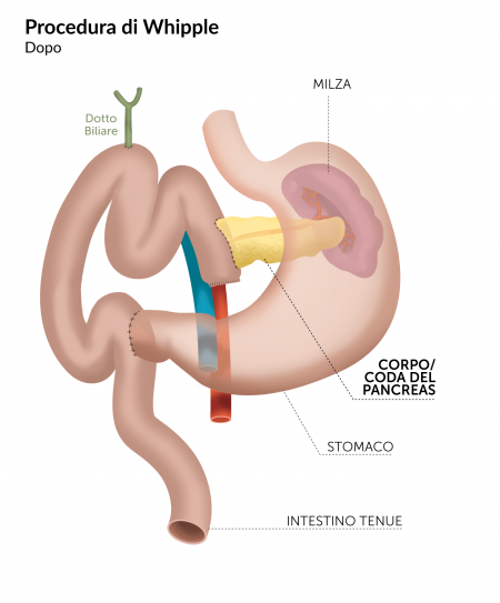 Duodenocefalopancreasectomiaprocedurawhippledopointervento Codice
