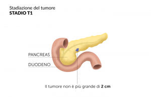 Tumore pancreas Stadio T1