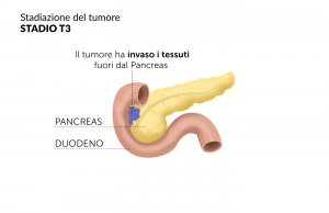 Tumore pancreas Stadio T3