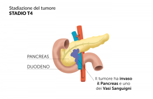 Tumore pancreas Stadio T4