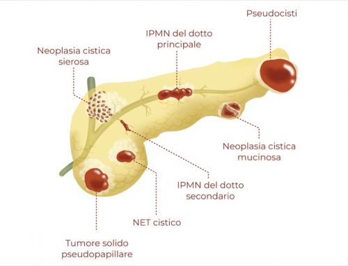 Cisti pancreatiche: alcune cose da sapere